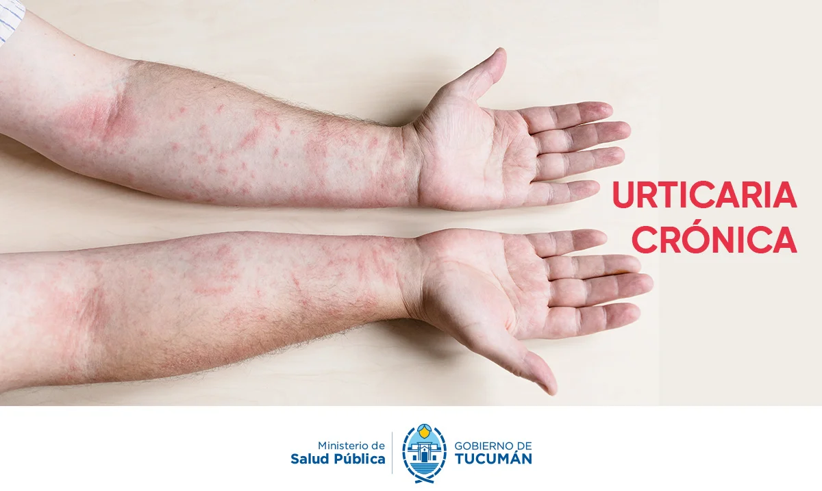 portada-de-urticaria-cronica